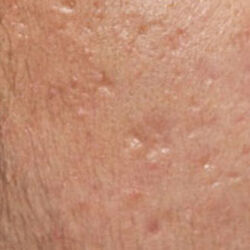 Example of acne